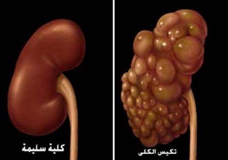كيف يتم علاج الكلي المتكيسة بدون جراحة؟