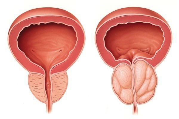 علاج تضخم البروستاتا