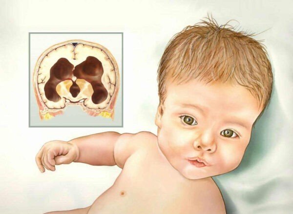 أمراض المخ والأعصاب عند الأطفال