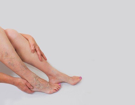 كيف يتم علاج ضعف الأوعية الدموية